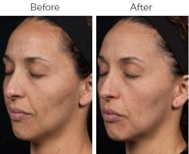 Body By Bloch (Steven Bloch, MD) laser treatment result — Highland Park, IL