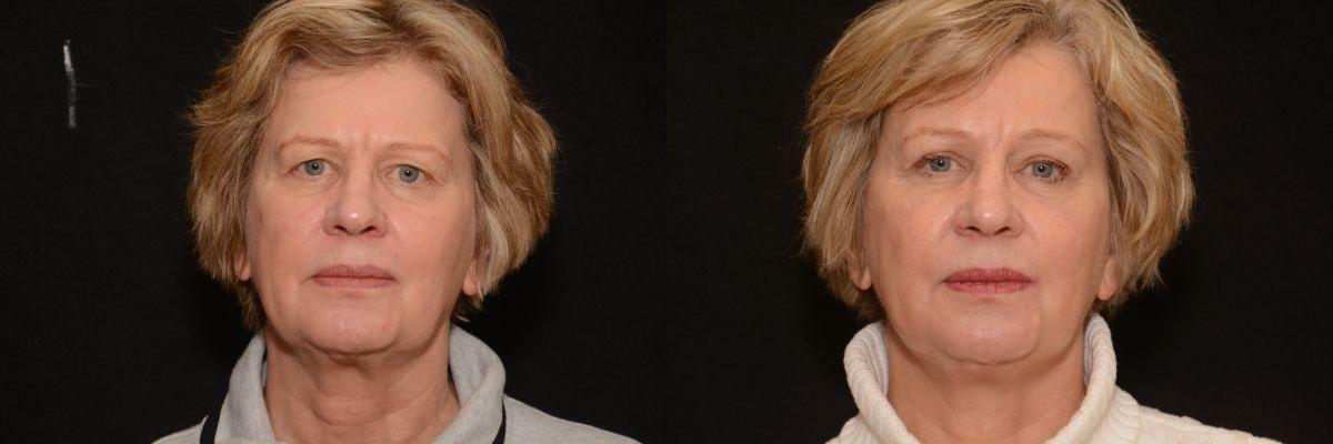 Body By Bloch (Steven Bloch, MD) eyelid lift result — Highland Park, IL