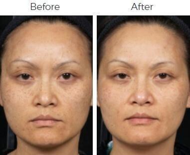Body By Bloch (Steven Bloch, MD) laser treatment result — Highland Park, IL