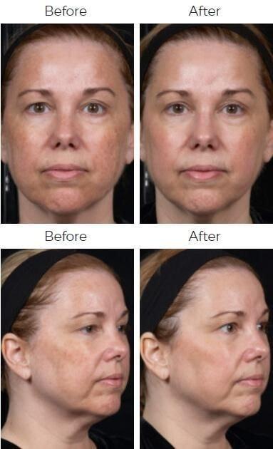 Body By Bloch (Steven Bloch, MD) laser treatment result — Highland Park, IL