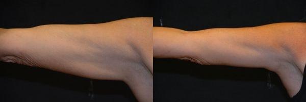 Body By Bloch (Steven Bloch, MD) arm lift result — Highland Park, IL