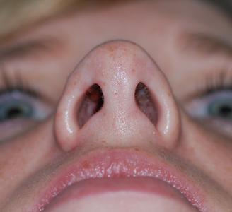 Rhinoplasty after at Michigan Facial Aesthetic Surgeons in Dearborn, MI