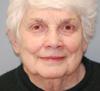 Michigan Facial Aesthetic Surgeons after — Dearborn, MI