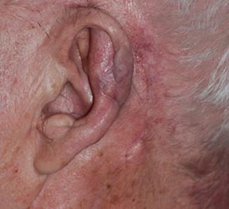 Michigan Facial Aesthetic Surgeons otoplasty after — Dearborn, MI