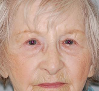 Michigan Facial Aesthetic Surgeons blepharoplasty after — Dearborn, MI