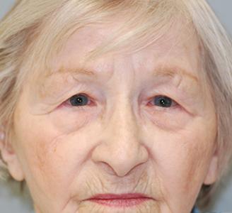 Blepharoplasty before at Michigan Facial Aesthetic Surgeons in Dearborn, MI