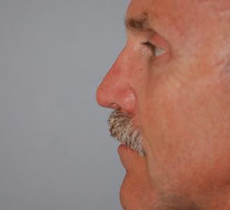 Rhinoplasty after at Michigan Facial Aesthetic Surgeons in Dearborn, MI