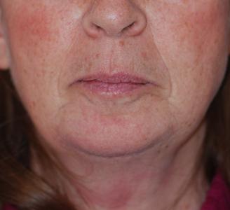 Michigan Facial Aesthetic Surgeons after — Dearborn, MI