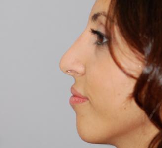 Michigan Facial Aesthetic Surgeons rhinoplasty after — Dearborn, MI