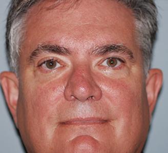 Blepharoplasty after at Michigan Facial Aesthetic Surgeons in Dearborn, MI