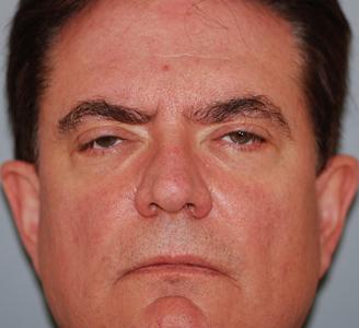 Blepharoplasty before at Michigan Facial Aesthetic Surgeons in Dearborn, MI