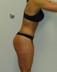 Tummy Tuck after at Barrington Plastic Surgery (Gregory M. Bazell, MD) in South Barrington, IL