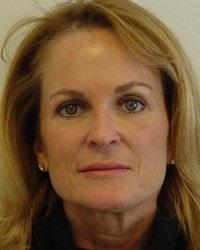 Barrington Plastic Surgery (Gregory M. Bazell, MD) eyelid lift after — South Barrington, IL