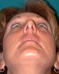 Barrington Plastic Surgery (Gregory M. Bazell, MD) rhinoplasty after — South Barrington, IL