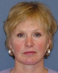 Chin Implant after at Barrington Plastic Surgery (Gregory M. Bazell, MD) in South Barrington, IL