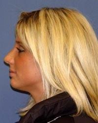 Barrington Plastic Surgery (Gregory M. Bazell, MD) rhinoplasty after — South Barrington, IL