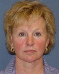 Chin Implant before at Barrington Plastic Surgery (Gregory M. Bazell, MD) in South Barrington, IL