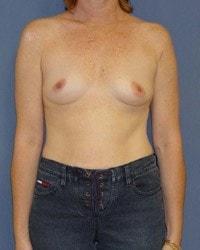 Breast Augmentation before at Barrington Plastic Surgery (Gregory M. Bazell, MD) in South Barrington, IL