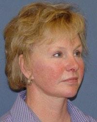 Chin Implant before at Barrington Plastic Surgery (Gregory M. Bazell, MD) in South Barrington, IL