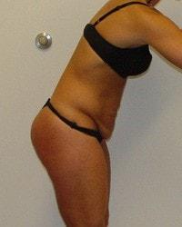 Tummy Tuck before at Barrington Plastic Surgery (Gregory M. Bazell, MD) in South Barrington, IL