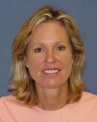 Barrington Plastic Surgery (Gregory M. Bazell, MD) eyelid lift after — South Barrington, IL