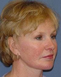Chin Implant after at Barrington Plastic Surgery (Gregory M. Bazell, MD) in South Barrington, IL