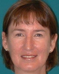 Barrington Plastic Surgery (Gregory M. Bazell, MD) eyelid lift after — South Barrington, IL
