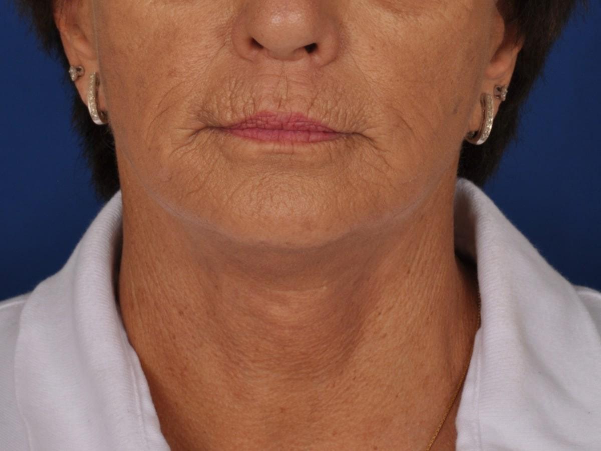 Edmon P. Khoury, MD facelift after — Greenwood Village, CO