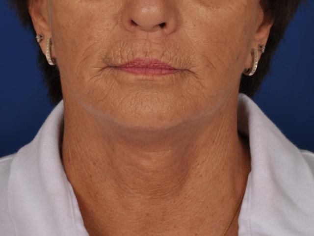 Deep Plane Facelift after at Edmon P. Khoury, MD in Greenwood Village, CO