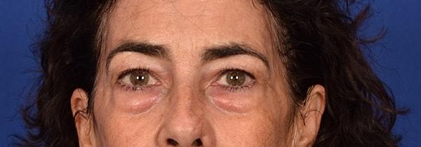 Blepharoplasty before at Edmon P. Khoury, MD in Greenwood Village, CO