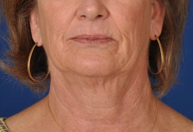 Deep Plane Facelift before at Edmon P. Khoury, MD in Greenwood Village, CO