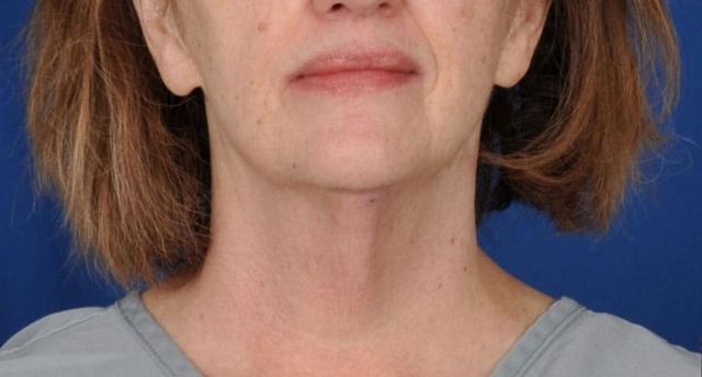 Deep Plane Facelift before at Edmon P. Khoury, MD in Greenwood Village, CO