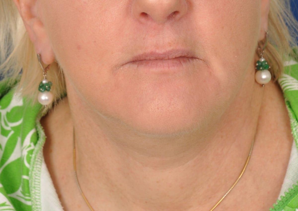 Edmon P. Khoury, MD facelift after — Greenwood Village, CO