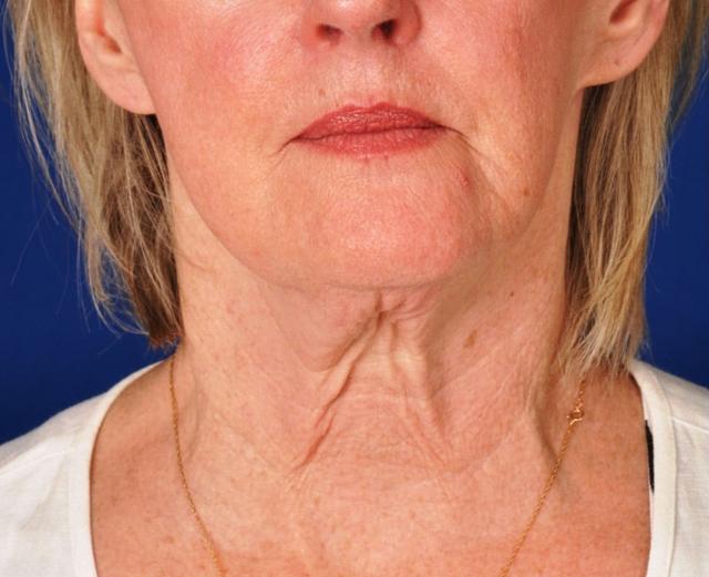 Deep Plane Facelift before at Edmon P. Khoury, MD in Greenwood Village, CO