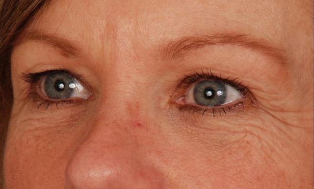 Blepharoplasty before at Edmon P. Khoury, MD in Greenwood Village, CO