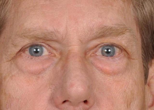 Blepharoplasty before at Edmon P. Khoury, MD in Greenwood Village, CO