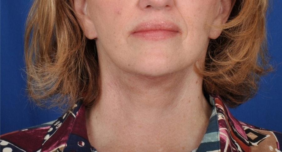 Edmon P. Khoury, MD facelift after — Greenwood Village, CO