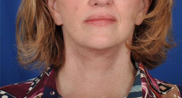 Deep Plane Facelift after at Edmon P. Khoury, MD in Greenwood Village, CO