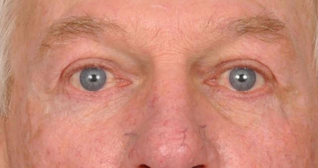 Blepharoplasty after at Edmon P. Khoury, MD in Greenwood Village, CO