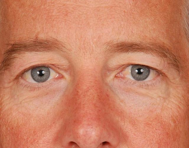 Blepharoplasty before at Edmon P. Khoury, MD in Greenwood Village, CO