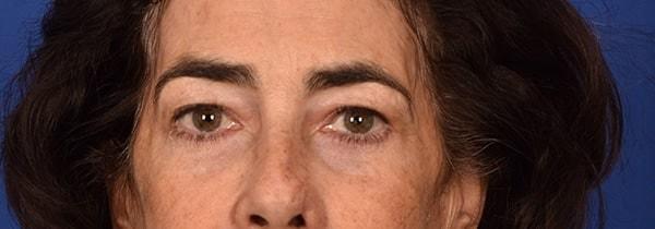 Blepharoplasty after at Edmon P. Khoury, MD in Greenwood Village, CO