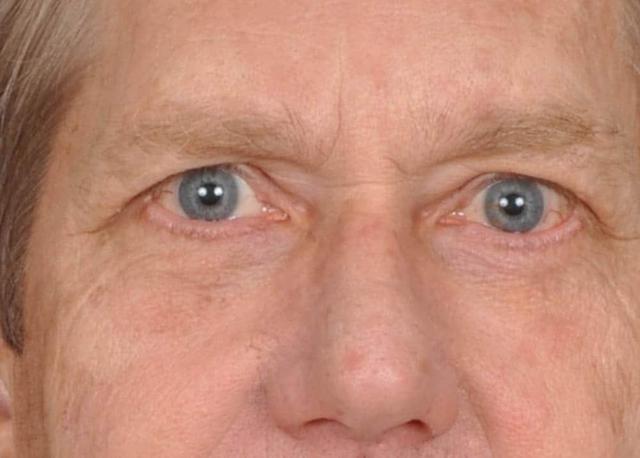 Blepharoplasty after at Edmon P. Khoury, MD in Greenwood Village, CO