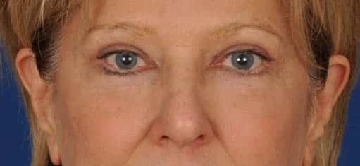 Blepharoplasty after at Edmon P. Khoury, MD in Greenwood Village, CO