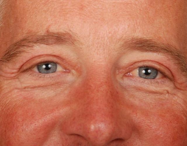 Blepharoplasty after at Edmon P. Khoury, MD in Greenwood Village, CO