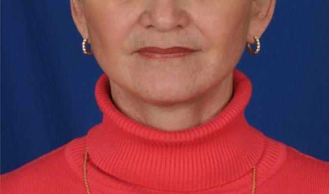 Deep Plane Facelift after at Edmon P. Khoury, MD in Greenwood Village, CO