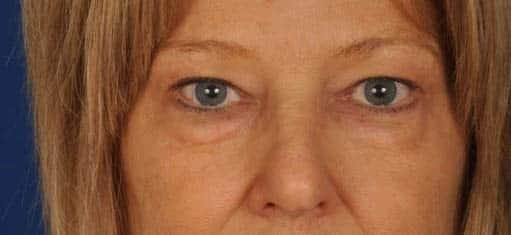Blepharoplasty before at Edmon P. Khoury, MD in Greenwood Village, CO