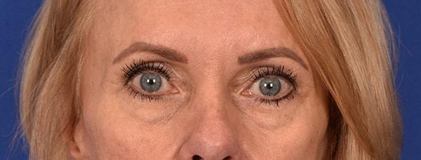 Blepharoplasty before at Edmon P. Khoury, MD in Greenwood Village, CO