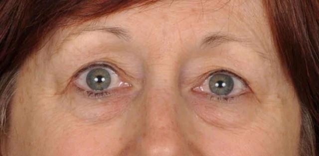 Blepharoplasty before at Edmon P. Khoury, MD in Greenwood Village, CO