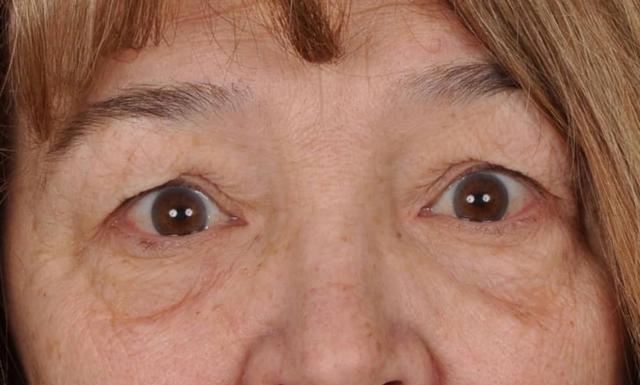 Blepharoplasty before at Edmon P. Khoury, MD in Greenwood Village, CO