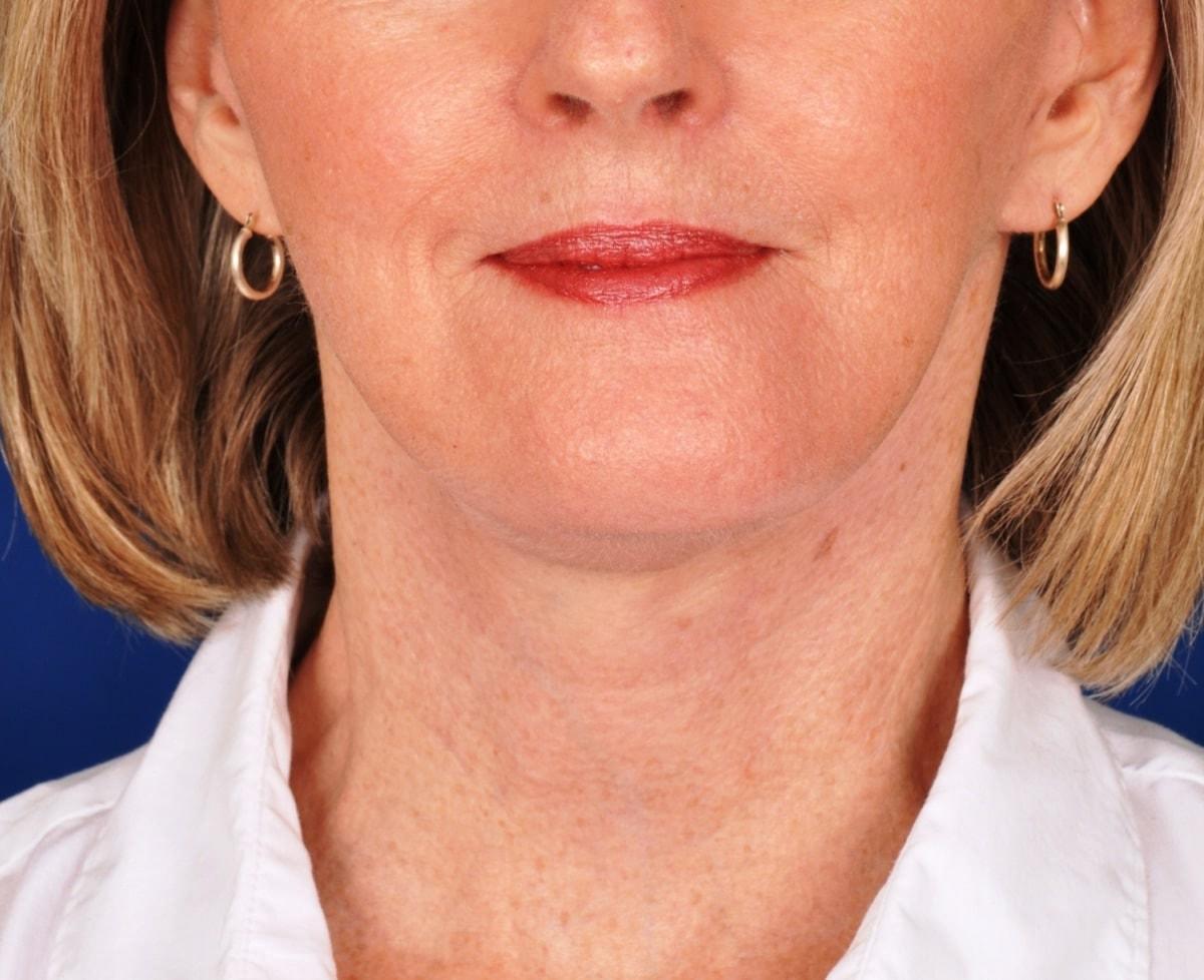 Edmon P. Khoury, MD facelift after — Greenwood Village, CO